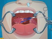 Operate Now Tonsil Surgery